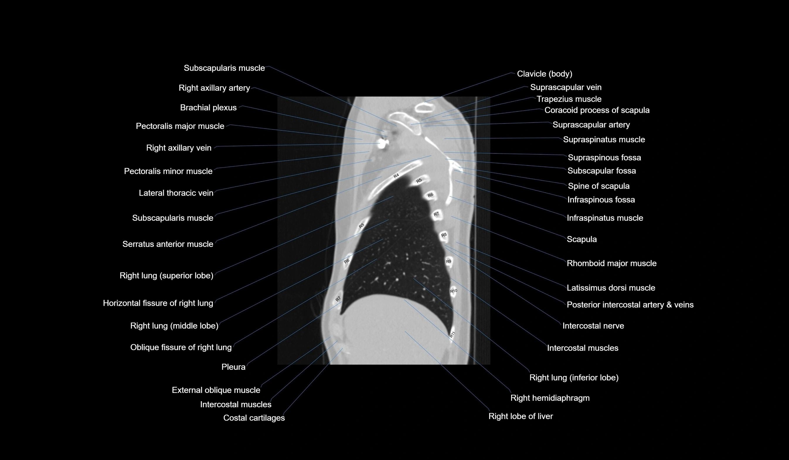 CT chest (thorax) lung window labelled sagittal cross sectional anatomy radiology image-00026.webp